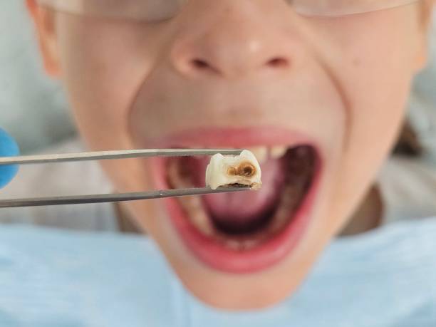 Best Knocked-Out Tooth (Avulsed Tooth) Treatment in Ocean Grove, MA
